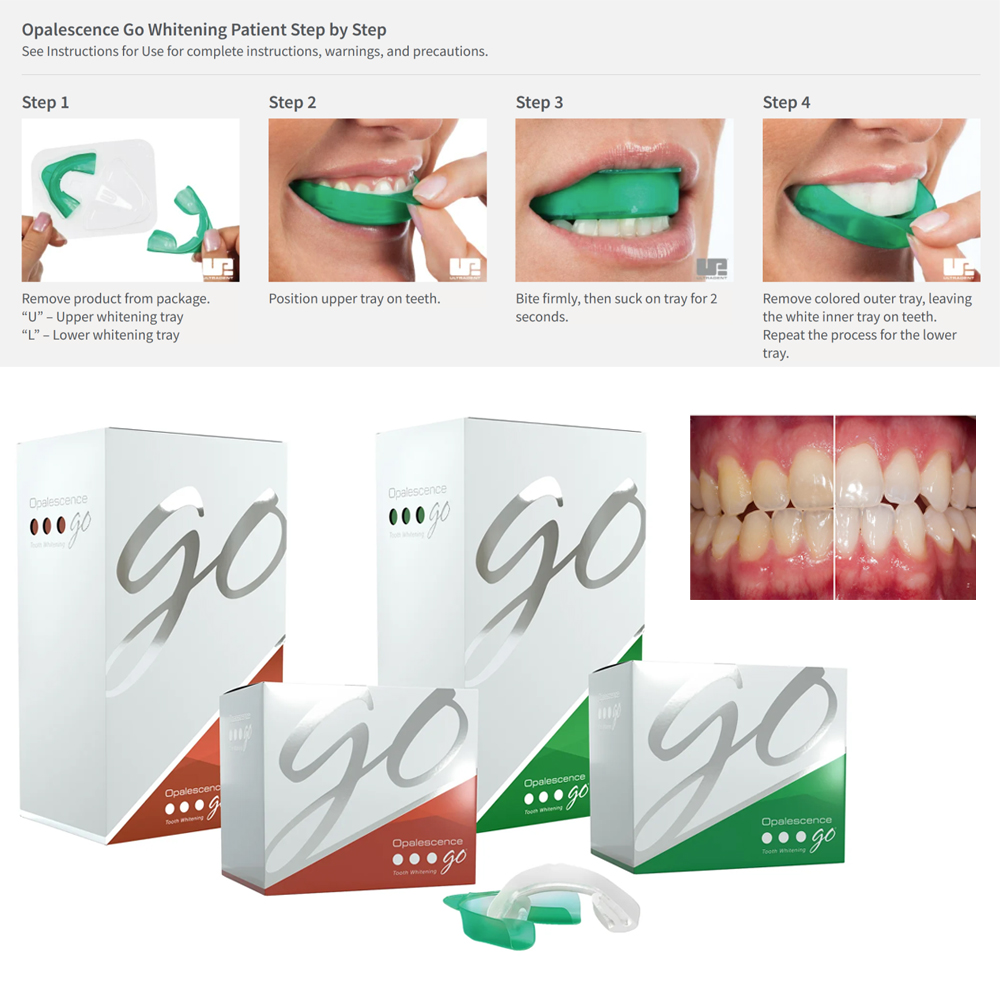 Teeth Whitening Kit At Home - 유백광 고 치아 미백 트레이, 집에서